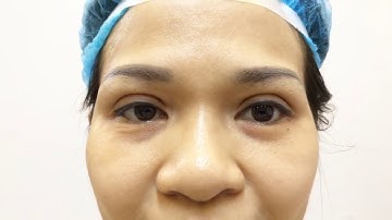 Cận Cảnh Nếp Mí Vừa Cắt Xong Tại Dr.Hải Lê.