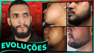 EVOLUÇÕES  COM MINOXIDIL (resultados dos inscritos) #155