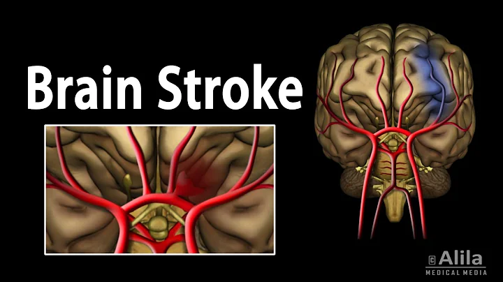 Brain Stroke, Types of, Causes, Pathology, Symptoms, Treatment and Prevention, Animation. - DayDayNews