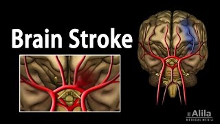 Brain Stroke, Types of, Causes, Pathology, Symptoms, Treatment and Prevention, Animation.