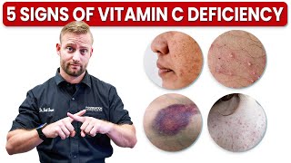 5 Signs of Vitamin C Deficiency | Dr Brett Berner