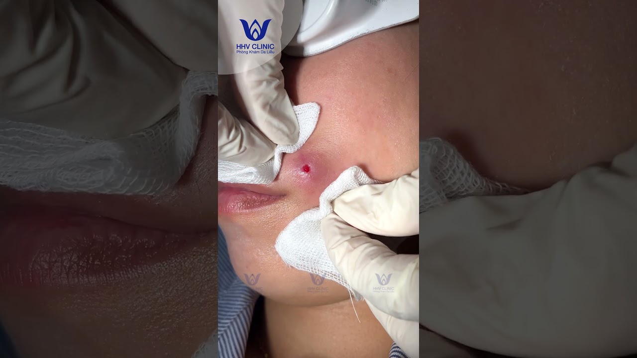 Nặn mụn áp xe ở vùng Miệng.
