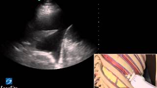 3D Lehrvideo: Ultraschallgestütze Thoracentesis Untersuchung - SonoSite Ultraschall