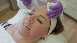 SkinPen: My Microneedling Experience