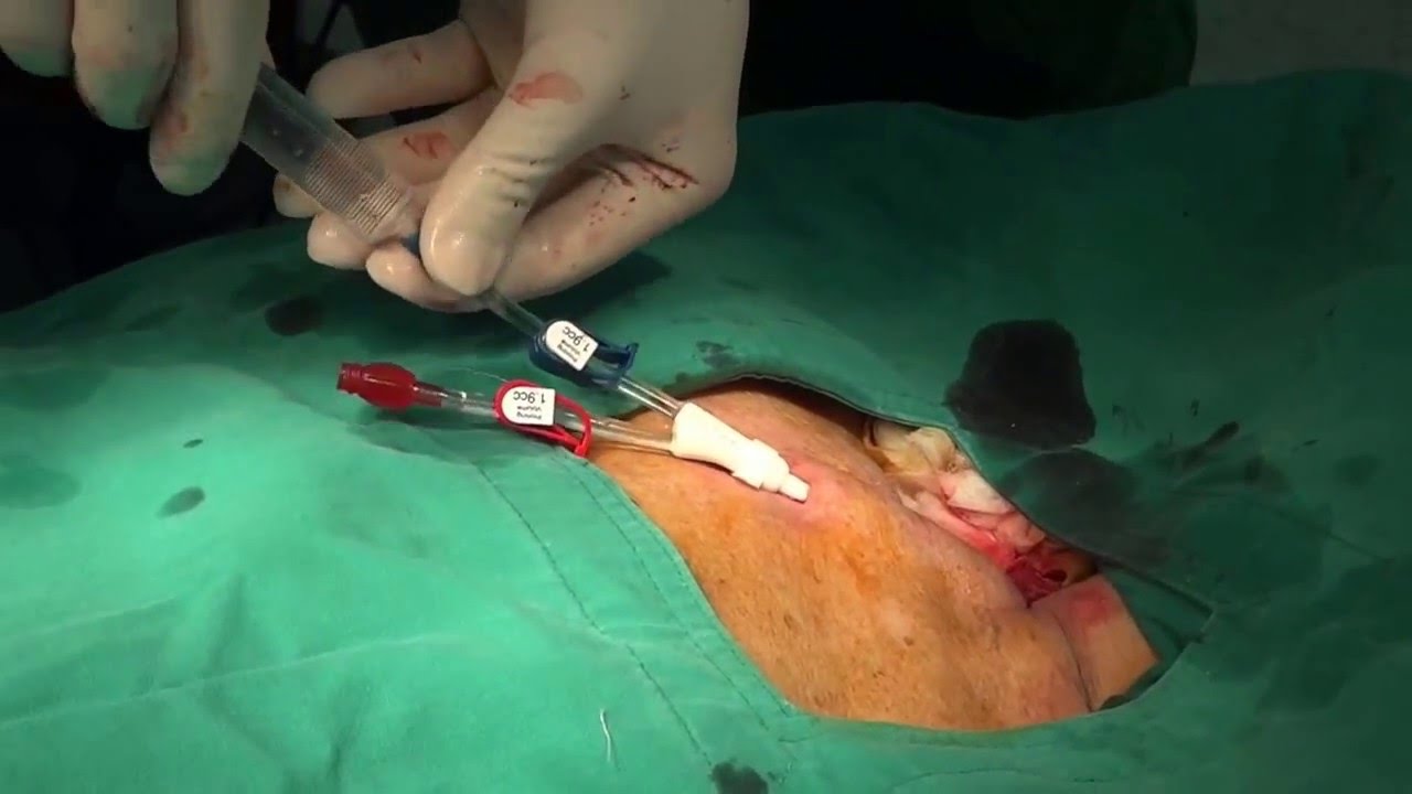 長期留置カテーテルを知る パーマネントカテーテルについて 医療と看護と透析で時々ce医療と看護と透析で時々ce