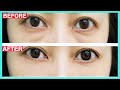 Eye Bags Removal Exercise & Massage