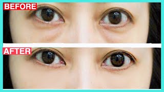 Eye Bags Removal Exercise & Massage