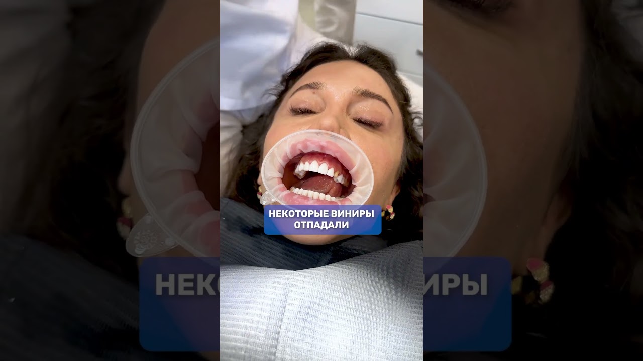 С таким случаем сильно переточеных зубов под виниры столкнулись в клинике.
