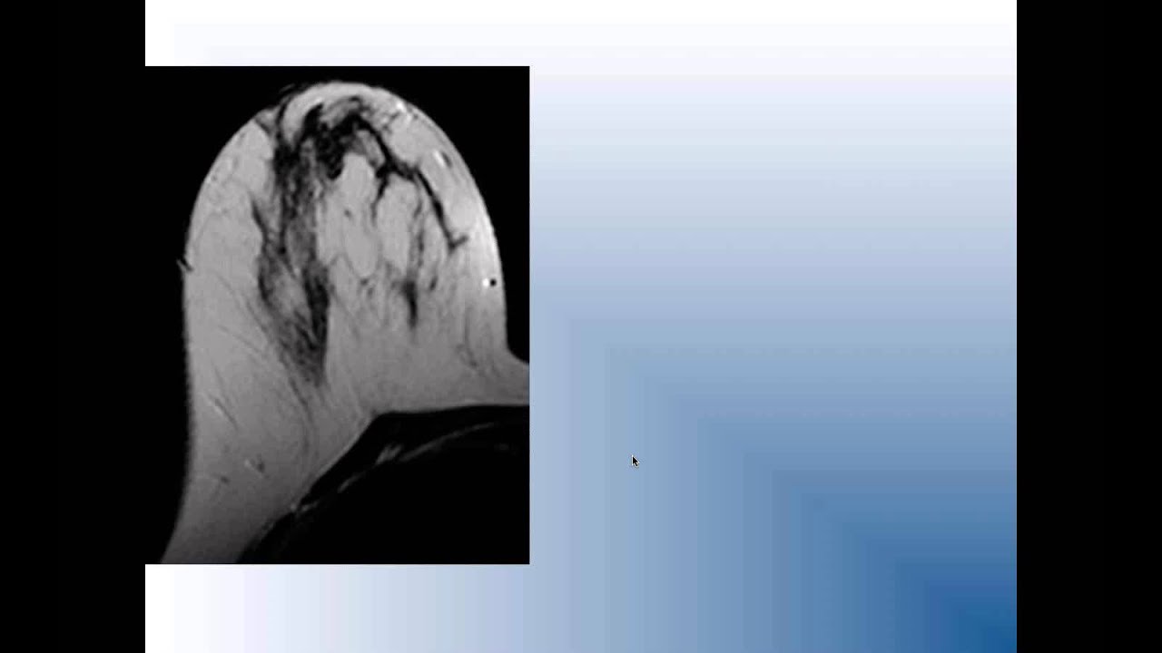 Breast Density What Is It And Why Does It Matter YouTube