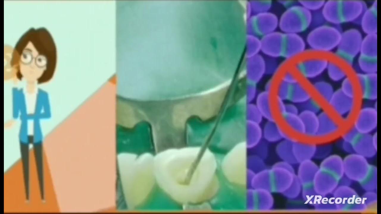 Chlorhexidine root canal irrigation solution. rootcanaltreatment 