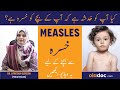 Khasra ki Alamat - Measles (rubeola) Symptoms and Treatment - Khasra Ka Ilaj