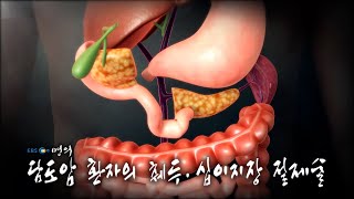 [명의 의학백과📖] 담도암 환자의 췌두 십이지장 절제술