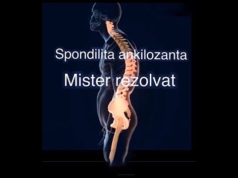 Spondilita Anchilozanta : Mister Rezolvat