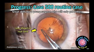 CataractCoach™ 2173: progress case 500 routine case