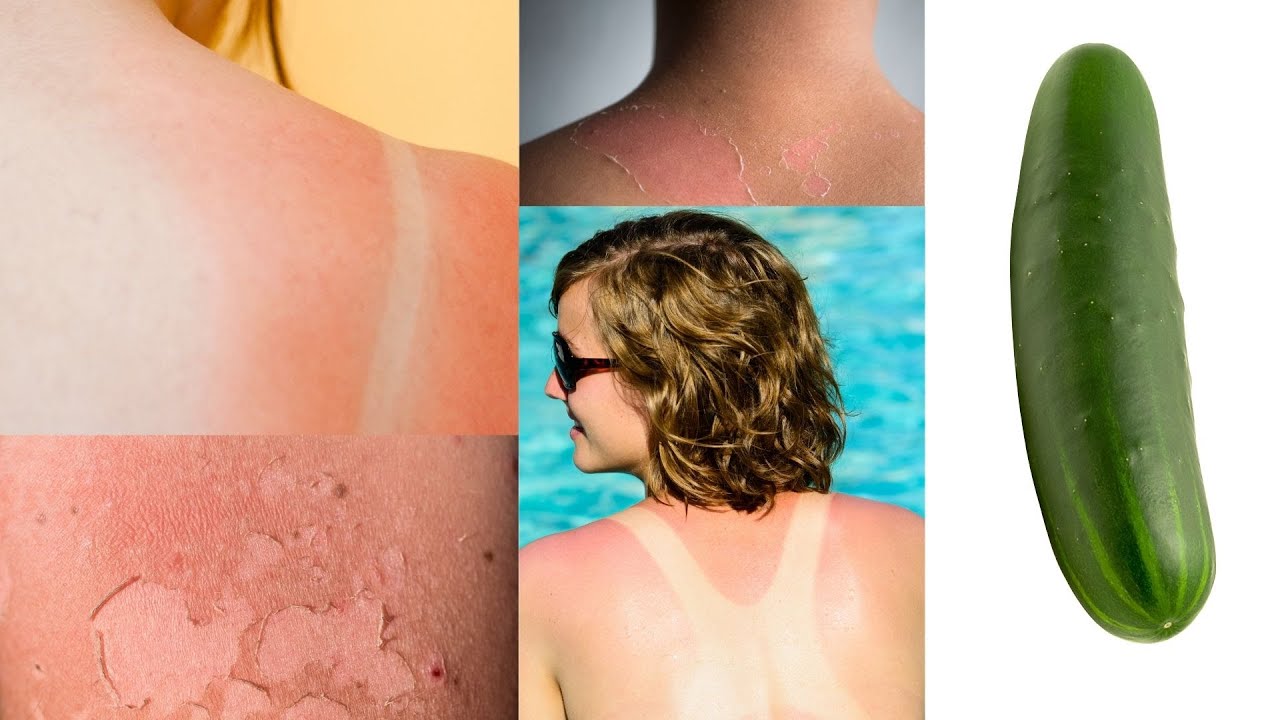 USE CUCUMBER TO HEAL SUNBURN OVERNIGHT 