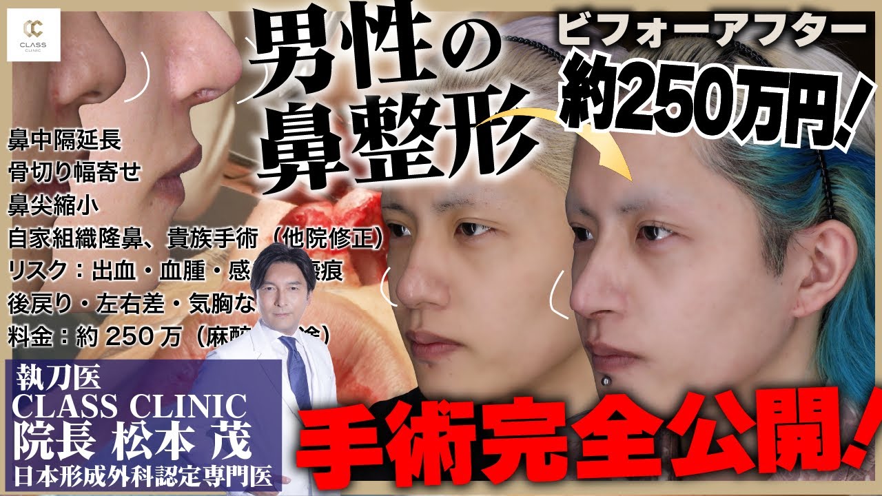 閲覧注意！】鼻整形の手術映像を完全公開します。肋軟骨を使った鼻中隔