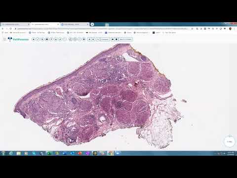 Video: Granuloma Eosinofilik Tulang: Rawatan Dan Komplikasi