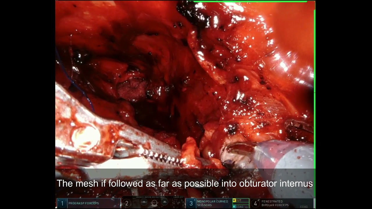 ICS 2021 Abstract #575 Robot-assisted removal of incorrectly positioned retropubic tension-free vaginal tape