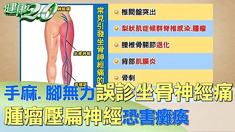 手麻、脚无力误诊坐骨痛 肿瘤压扁神经恐害瘫痪 健康2.0 - 天天要闻