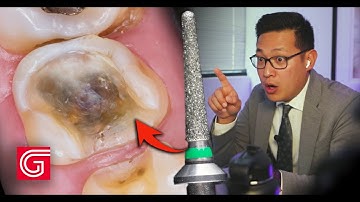 HOW TO Prepare Tooth for ONLAY & INLAY Restoration