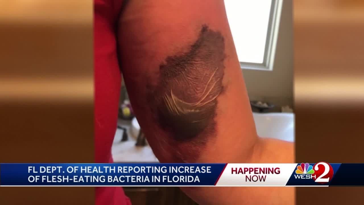 Health department reports increase of flesheating bacteria in Florida