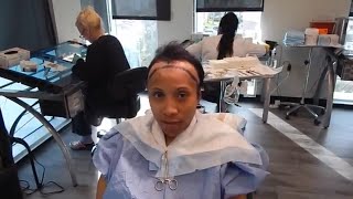 Get a Great Hair Transplant, Naturally with Natural Transplants, Hair Restoration Clinic