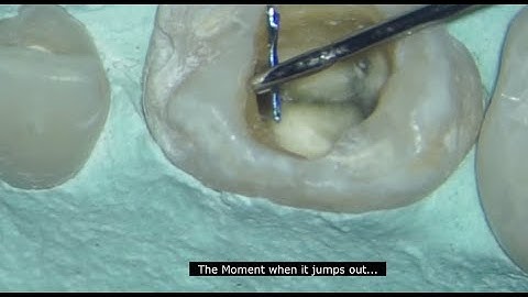 Broken File retrieval from a lower  molar | u file technique for instrument retrieval | ReRCT