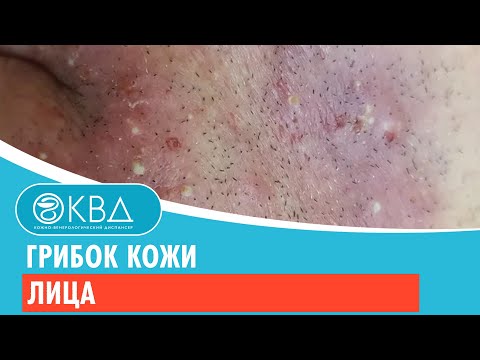 ? Грибок кожи лица. Клинический случай №380