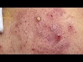Treatment of pustules and inflammatory acne 84  loan nguyen