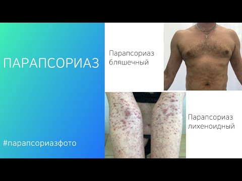 Видео: Псориазис при деца: симптоми, лечение и др