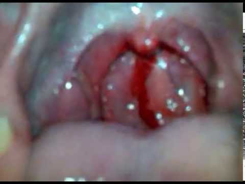 recurring strep in throat Adult