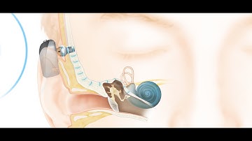 How the Cochlear™ Baha® Connect System Works