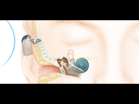 How the Cochlear™ Baha® Connect System Works