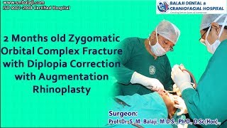 Zygomatico-Orbital Complex Fracture With Diplopia Correction With Augmentation Rhinoplasty