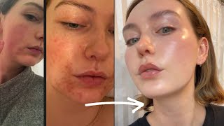 From rosacea + acne to glass skin - this skincare works