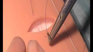 Vertical Mattress Suture