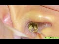 ASMR：この黒い耳垢、どこから出てきたの？