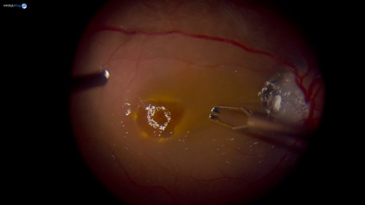 Surgery Optic Nerve Pit with CSR Dr. Manish Nagpal YouTube