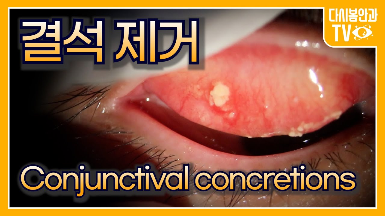 결막결석 제거, 그동안 어떻게 살아오신건가요 ??? - YouTube