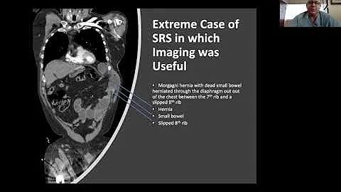 Slipped Rib Syndrome Diagnosis and Repair