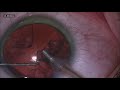 Multifocal iol sifi in soft cataract by adrian gavanescu at malaxa clinical hospital