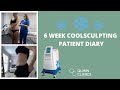 COOLSCULPTING - WHAT TO EXPECT | FREEZE FAT OFF! Does CoolSculpting Work? | Quinn Clinics