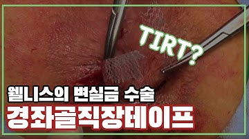 변실금을 위한 경좌골직장 테이프TIRT(Transischiorectal tape) for  fecal  incontinence