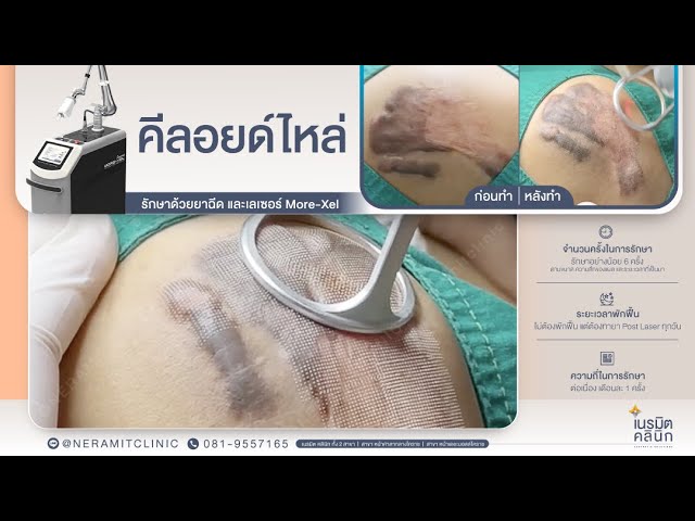 รักษาแผลเป็น EP.297/แผลคีลอยด์หัวไหล่รักษายังไง? @หมอปุ๊ Neramit Clinic