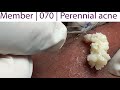 Acne Treatment Huong Da Nang# 070 |  Perennial acne