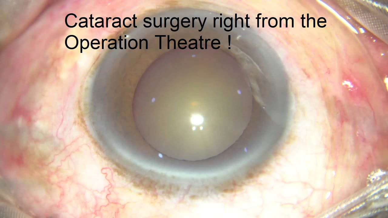 Eye Know series Cataract surgery LIVE / ছানি অপারেশন ভিডিও (Bengali) Dr. Sourav Kumar Bose