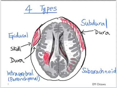 Pneumothorax Part 1  Doovi