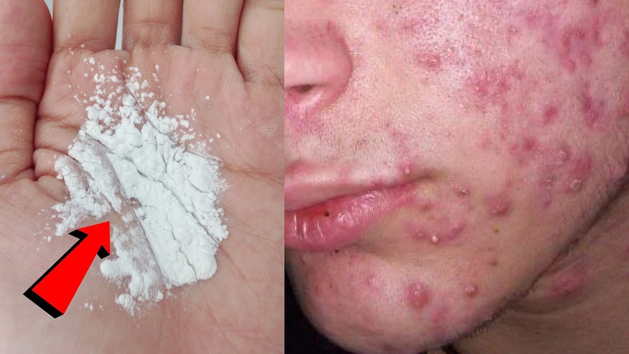 इसे लगाने से पिंपल्स हमेशा के लिए ख़त्म हो जाएगा | pimples remove on face at home - YouTube