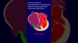 Аномалия Эбштейна - гемодинамика. #shorts