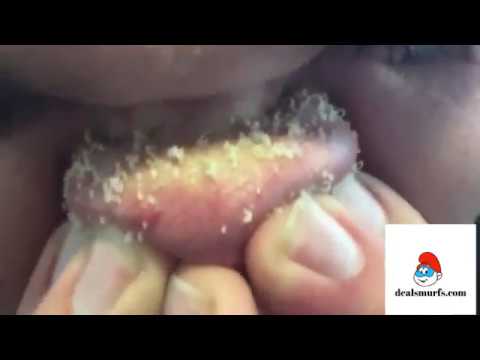 Nose Full Of Blackheads.Blackhead Pore Strips, Blackhead Remover For Nose,
